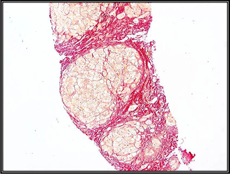 Picrosirius Red stain of human liver biopsy showing collagen